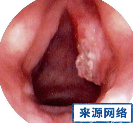 喉癌 喉癌的表現 喉癌的症狀