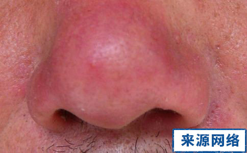 酒渣鼻的症狀 酒渣鼻治療方法 酒渣鼻圖片