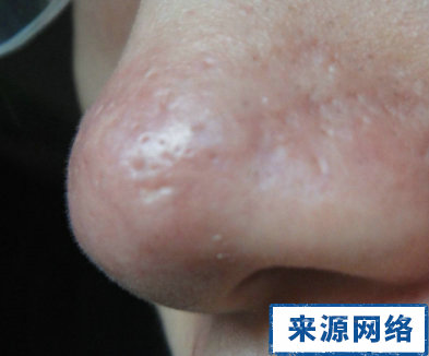 酒渣鼻的症狀 酒渣鼻治療方法 酒渣鼻圖片