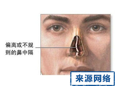 什麼是鼻中隔偏曲 鼻中隔偏曲 鼻中隔偏曲危害