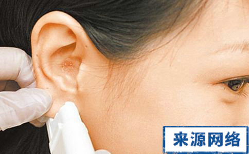打耳洞的注意事項 打耳洞有注意什麼 打耳洞耳朵發炎
