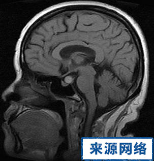 耳源性腦膜炎 腦膜炎 並發症 治療 急性化膿性炎症