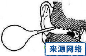 耵聍 外耳道沖洗法 耵聍栓塞 油耳 耳鳴 耵聍栓塞症狀