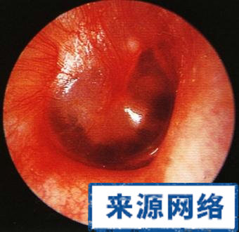 慢性化膿性中耳炎 中耳炎 臨床症狀 檢查所見
