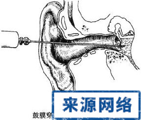 如何治療 急性 中耳炎 化膿性中耳炎 鼓膜穿孔