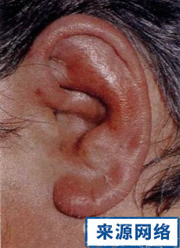 耳廓軟骨膜炎 症狀 並發症 耳 斷耳瘡 耳廓假囊腫