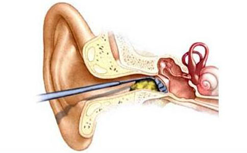 掏耳朵誤區 如何正確掏耳朵 耳屎是用來保護耳朵的嗎